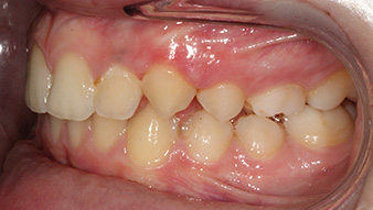 john carlo after treatment