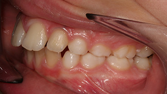 john carlo before treatment