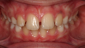 john carlo before